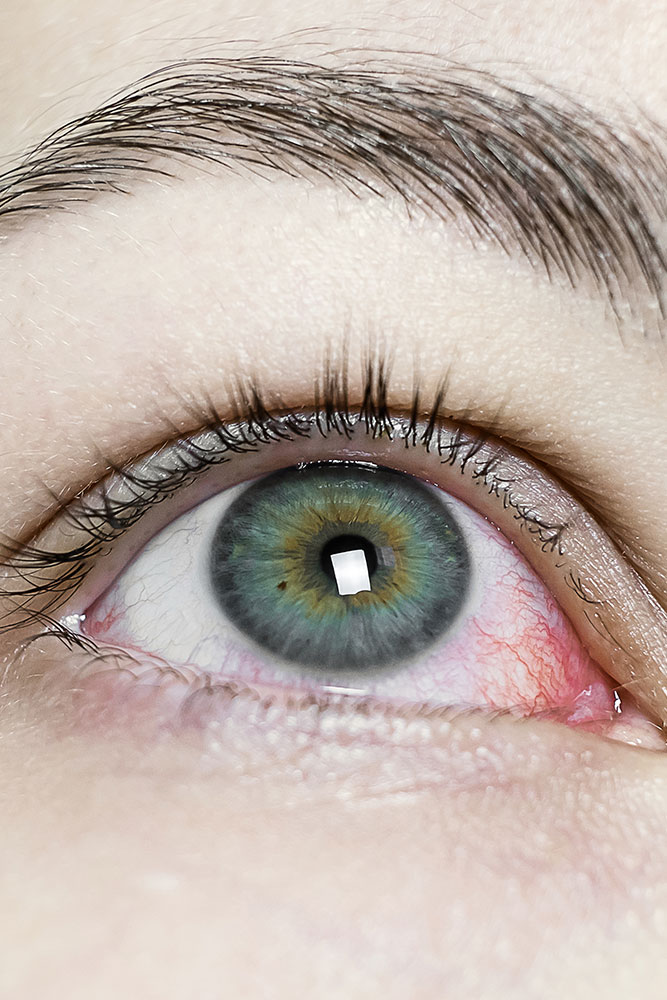 Descubre cómo aliviar tus alergias oculares, ¡Di adiós a la picazón y el enrojecimiento!