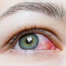 El ojo seco causa ardor, enrojecimiento y visión borrosa. Conoce sus causas, síntomas y tratamientos en la Sociedad de Cirugía Ocular.
