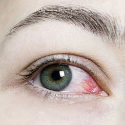 Ojo seco en Bogotá: manejo médico y terapéutico en el Spa de Ojos de la SCO