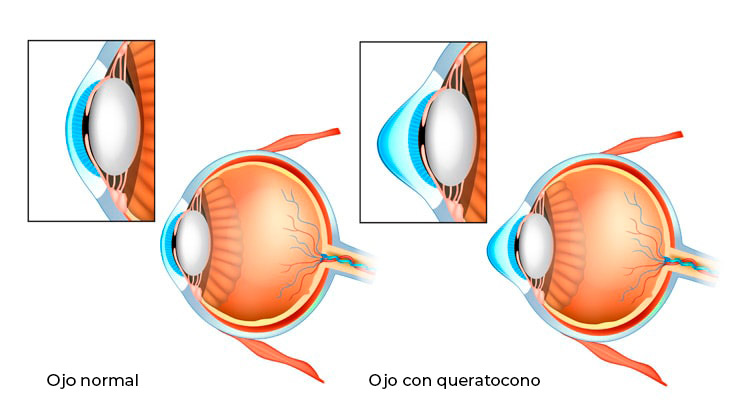 Queratocono