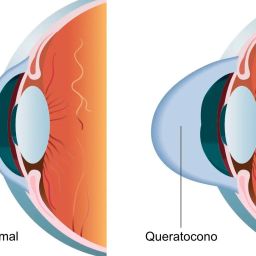 Queratocono en Bogotá: diagnóstico y tratamiento para una visión más clara